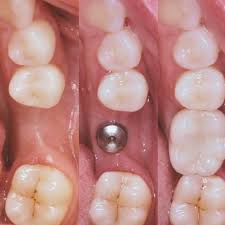 Dentist Near Me. Dental Implant in Mahalunge, Baner, Pune