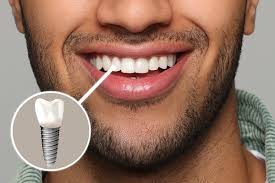 Dentist Near Me. Dental Implant in Mahalunge, Baner, Pune