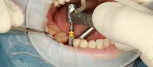 Dentist Near Me. Dental Implant in Mahalunge, baner, Pune